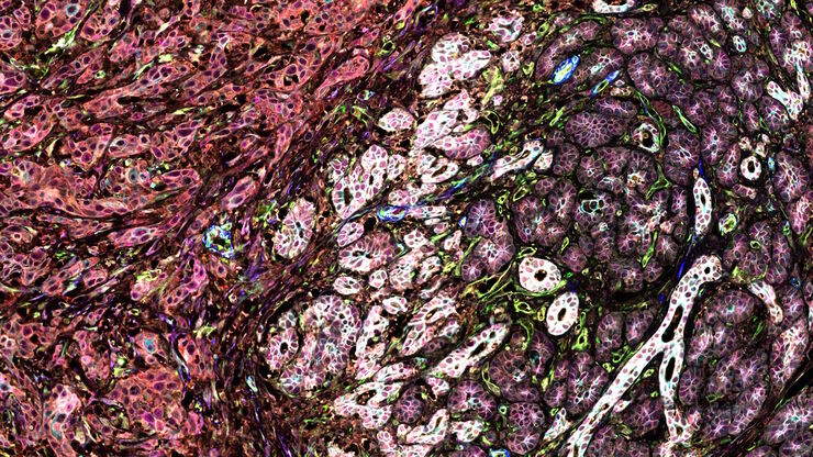 Pancreatic Ductal Adenocarcinoma with 11 Aerobic Glycolysis/Warburg Effect biomarkers shown – BCAT, Glut1, HK2, HTR2B, LDHA, NaKATPase, PCAD, PCK26, PKM2, SMA1, and Vimentin. Pancreatic Ductal Adenocarcinoma with 11 Aerobic Glycolysis/Warburg Effect biomarkers shown – BCAT, Glut1, HK2, HTR2B, LDHA, NaKATPase, PCAD, PCK26, PKM2, SMA1, and Vimentin.